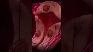 How Does Uterine Fibroid Embolization UFE work uterinehealth womenshealth healthshorts shorts [upl. by Lattonia627]