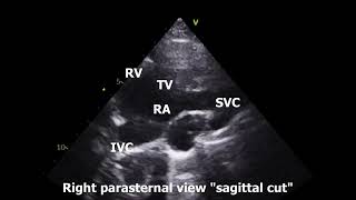 Right Parasternal Echo View [upl. by Erlinna]