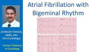 Atrial Fibrillation with Bigeminal Rhythm [upl. by Pelligrini565]