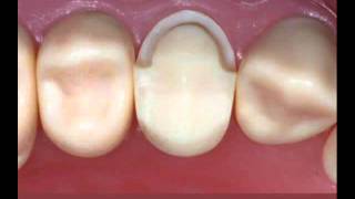 Metal Ceramic Crown Preparation on Premolar FourthMolar com [upl. by Woodman]