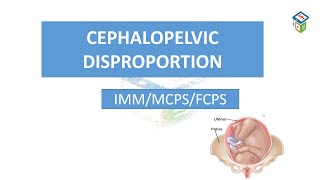 CPD  cephalopelvic disproportion  cpsp format  mcqs  labour module [upl. by Ahseryt]