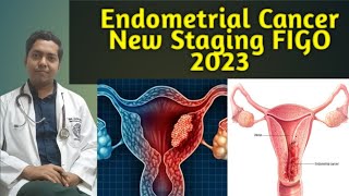 endometrial cancer carcinoma endometrium staging FIGO 2023 staging recent FIGO staging [upl. by Masao577]