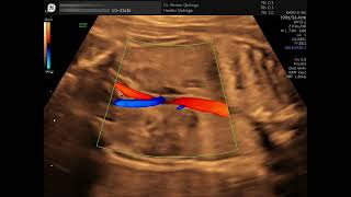 Doppler color y agenesia renal unilateral fetal shorts [upl. by Jary726]