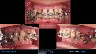 Orthodontic treatment of a severe perio case [upl. by Abrahamsen]