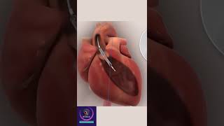 Heart Stent Aortic Valve shorts heartvalve [upl. by Nawuj]