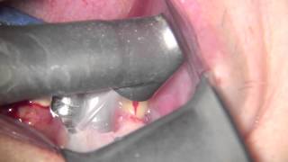 erbium laser periimplantitis treatment [upl. by Onitsirc]