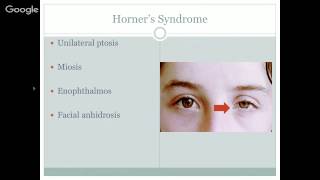 Central Vestibular Syndromes and Rehabilitation [upl. by Ttekcirc]