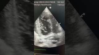 Apical thrombus echocardiography cardiacimaging cardiology [upl. by Gertrud]