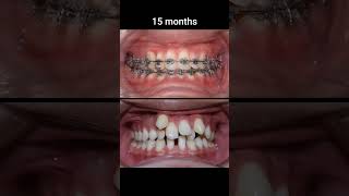 Braces very crooked braces orthodontist shorts viral trending facts tooth neet2025 neet [upl. by Chita]