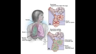 Pneumonia and Tuberculosis explained in UrduHindi [upl. by Nandor]