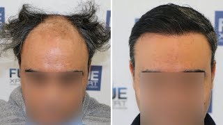 FUE Hair Transplant 3500 Grafts in NW V Dr Juan Couto  FUEXPERT CLINIC Madrid Spain [upl. by Melentha]