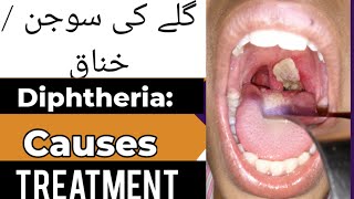 What is Diphtheria Causes of diphtheria sign and symptoms  treatment for diphtheria in Hindi [upl. by Axela]