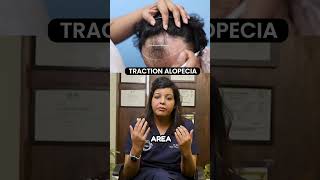 Traction Alopecia  Hair Transplant Clinic  Dadu Medical Centre [upl. by Neelrihs315]