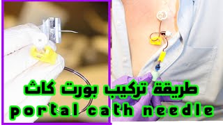 تركيب ابرة القسطرة الوريدية البورت كاث port a cath [upl. by Noir]