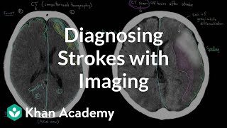 Diagnosing strokes with imaging CT MRI and Angiography  NCLEXRN  Khan Academy [upl. by Fuld895]