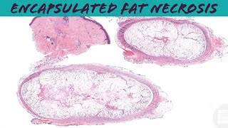 Posttraumatic fat necrosis encapsulated subcutaneous fat necrosis pathology dermpath dermatology [upl. by Eta]