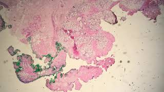 Mucoepidermoid Carcinoma Intermediate Grade [upl. by Eitisahc173]