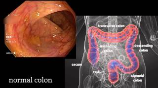 Colonoscopy A Journey Though the Colon and Removal of Polyps [upl. by Erimahs]