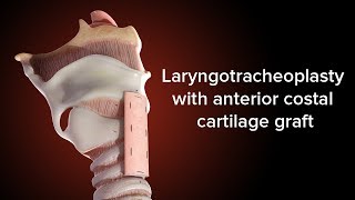 Medical Animation Anterior Cricoid Split  Cincinnati Childrens [upl. by Jacquetta]