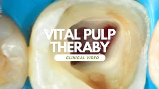 vital pulp theraby for immature tooth full microscopic clinical case [upl. by Metzger]