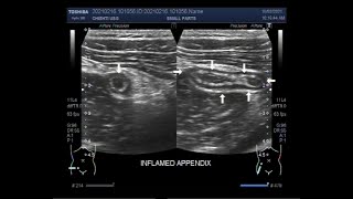 The scanning and localization of Acute Appendicitis [upl. by Irakuy]