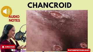 Chancroid Causes Symptoms Treatment and Prevention Audio Notes [upl. by Freya]