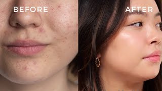 How to cover Acne like a PRO for Natural flawless Skin  Tips for covering Acne amp Textured Skin [upl. by Bannasch68]