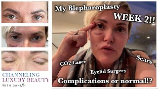 Blepharoplasty Recovery Week 2 What to Expect Eyelid Surgery amp CO2 Laser Channeling Luxury Beauty [upl. by Winn]