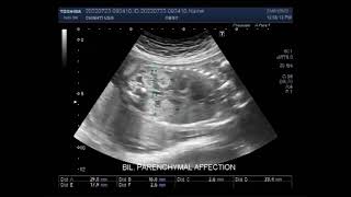 Fetal echogenic Kidneys with a distended urinary bladder [upl. by Chesnut]