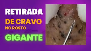 Cravos pretos profundos e gigantes  Tirando cravos e EspinhasVIDEO SATISFATÓRIO E RELAXANTE 02 [upl. by Woodson]