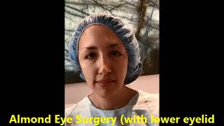 Almond Eye Surgery with Canthoplasty [upl. by Chamberlin250]