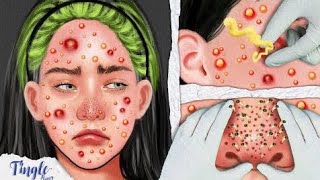 ASMR Bam Blackhead and Acne Removal Animation  Pimple Removal Lighten [upl. by Sukram]