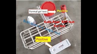 K39 test positive Formal gel test positive Aldehyde test positive Leishmaniasis Kala Azar [upl. by Oba]