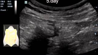 Descending colon diverticulitis sonography [upl. by Mehta990]