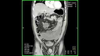 Midgut volvulus coronal [upl. by Llerrud472]