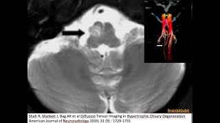 2 Hypertrophic olivary degeneration brain stem anatomy GABA GuillainMollaret MRI imaging [upl. by Ycart927]