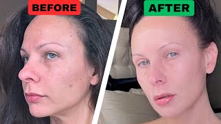 How to Fix Hyperpigmentation amp Dark Spots  FAST amp Inexpensive [upl. by Kaela452]