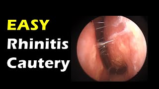 Very Easy Rhinitis treatment simple cautery [upl. by Lombardi]