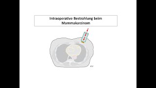 Intraoperative Bestrahlung beim Mammakarzinom  Strahlentherapie Prof Hilke Vorwerk [upl. by Stesha978]