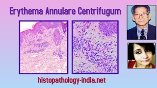 Pathology of Erythema Annulare Centrifugum  Dr Sampurna Roy MD dermpath dermatopathology [upl. by Hescock225]