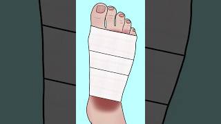 ASMR Remove isopod parasite from infected foot P2 asmr animation satisfying viralvideo shorts [upl. by Sherye]