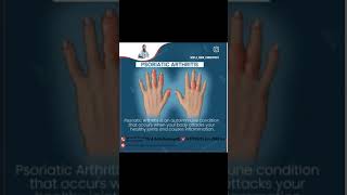 Psoriatic arthritis treatment [upl. by Nnyletak87]