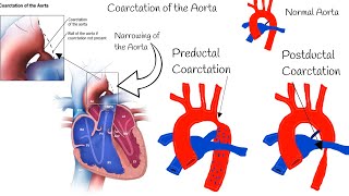 Coarctation of the Aorta [upl. by Eryt]