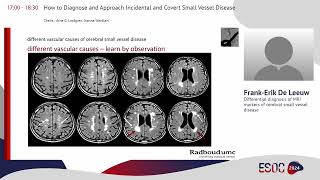 ESOC 2024 on demand session quotHow to Diagnose and Approach Incidental amp Covert Small Vessel Diseasequot [upl. by Meggi]