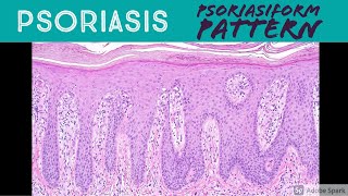 Psoriasis amp Psoriasiform Dermatitis Pattern  Inflammatory Dermpath Basics for Dermatology Pathology [upl. by Ingra]