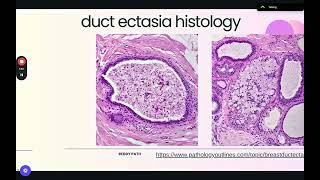 Duct Ectasia Histology Explanation [upl. by Kcirddahc549]