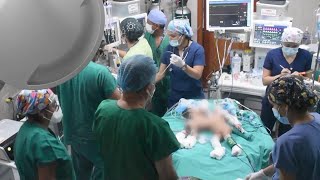 Babies Born Conjoined at the Abdomen Separated in Surgery [upl. by Priscella836]