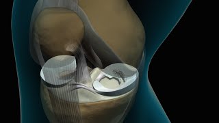 Torn Knee Meniscus Repair [upl. by Etnoval]