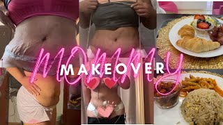 1 week post OP mommy makeOVER tummy tuck lipo 360 breast reduction Dr WilliamMiami [upl. by Onailil]