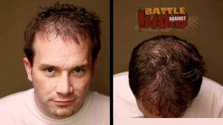 Hair Transplant Results  12 Month Timelapse Before and After  Bosley Medical [upl. by Ennaitsirhc]